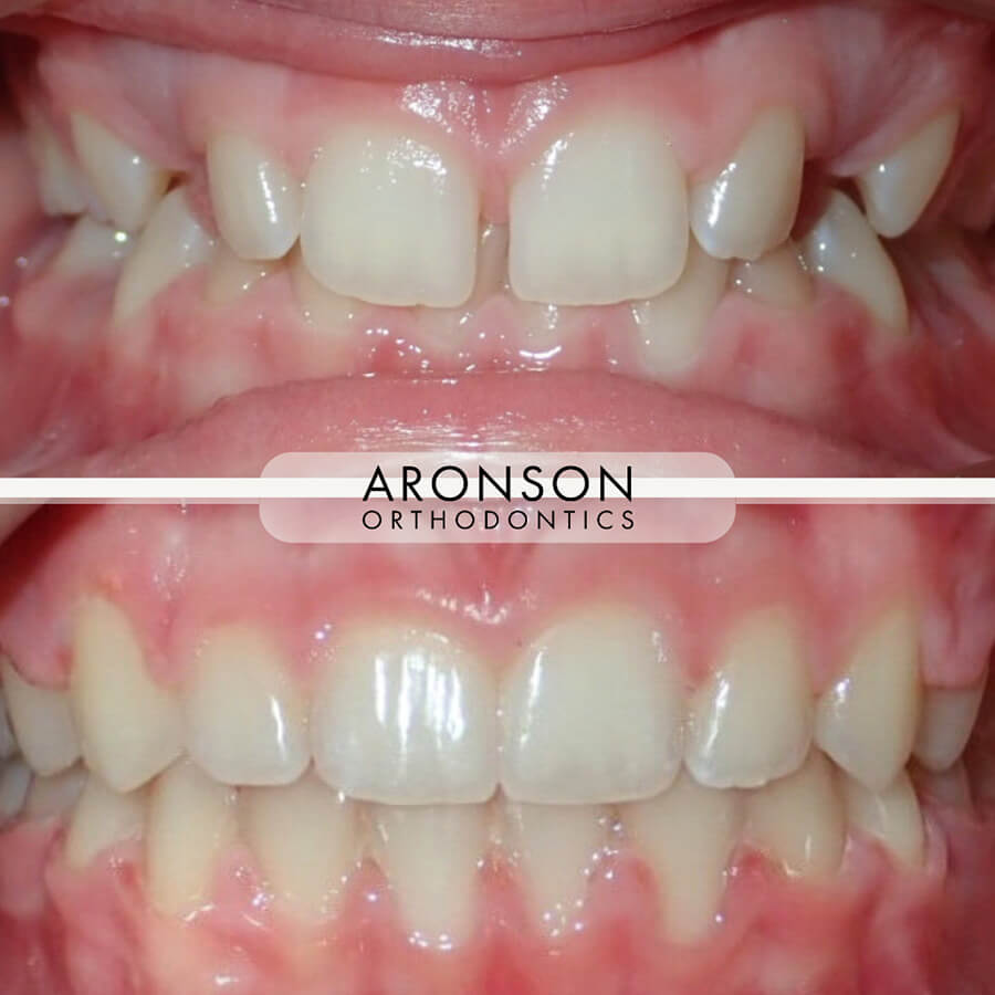 Severe Deep Overbite Correction

This patient shows the correction of a severe deep overbite with spacing between the upper front teeth, rotated upper lateral incisors, and a Class II bite. Treatment involved braces, elastic wear, and about 20 months of precise orthodontic care.

A deep overbite isn’t just a cosmetic concern — it can cause premature wear on the front teeth and strain on the bite over time. Functionally, this patient’s bite was balanced and stabilized, while esthetically, aligning and rotating the upper lateral incisors properly created a broader, more natural-looking smile.