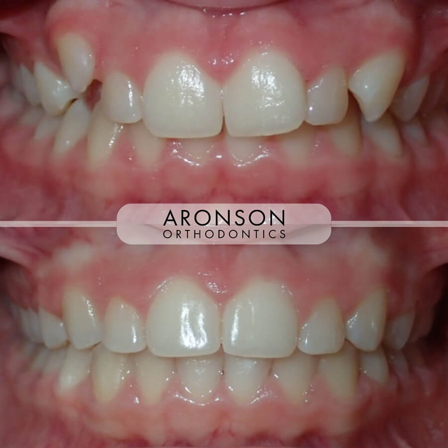 High (ectopic) Canine, Deep bite, and crowding

This patient was treated with braces and involved correction of a moderate deep overbite, an ectopic (high) canine, and excess overjet caused by a Class II malocclusion. Treatment included the use of braces and elastics over approximately 18 months.

By reducing the overbite and overjet, the bite was brought into proper function — allowing for balanced contact and natural wear of the front teeth. The final result represents both a functional improvement and a more harmonious, esthetic smile.