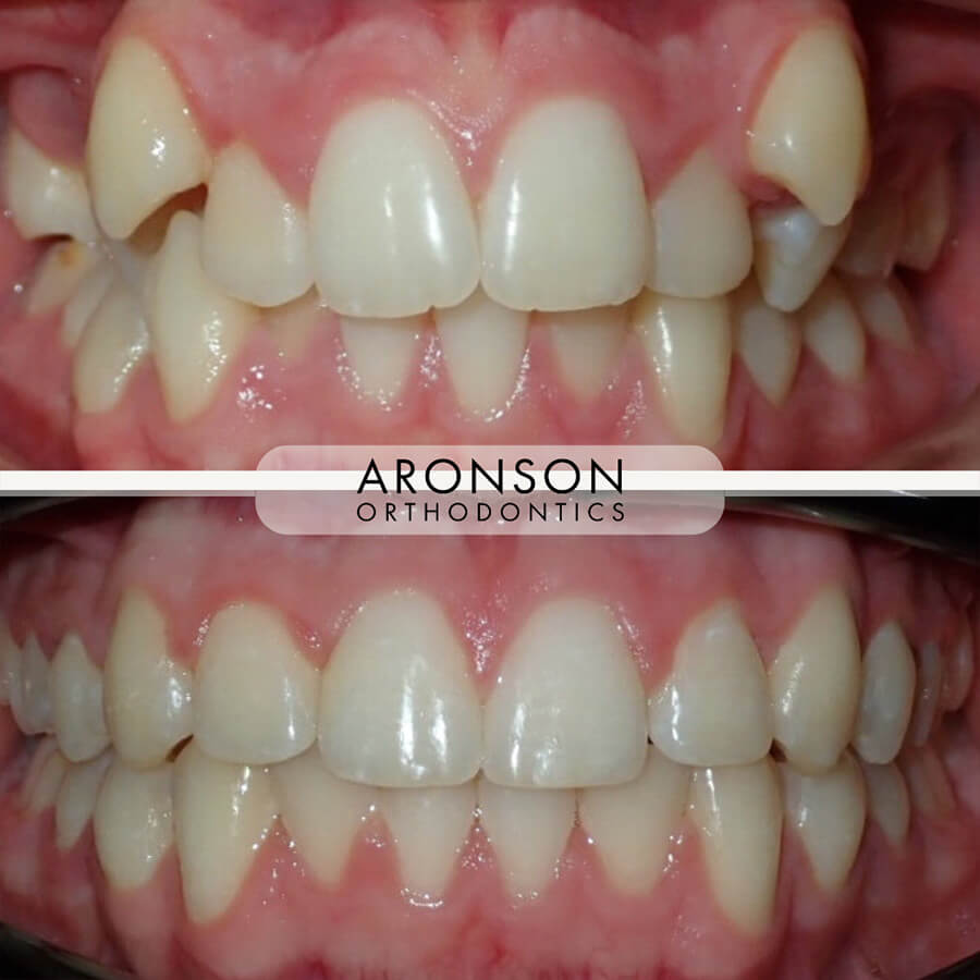 Severe crowding, Deep overbite, Ectopic canines, Midline discrepancy

This patient was treated for severe dental crowding, a deep overbite, and non-coincident dental midlines using braces, elastics, and interproximal reshaping. The result is both an esthetic and functional improvement, with a more balanced bite and harmonious smile.

Following treatment, the bite forces are more evenly distributed, leading to slower wear on the teeth and enhanced long-term periodontal stability — a healthier, more stable smile overall.