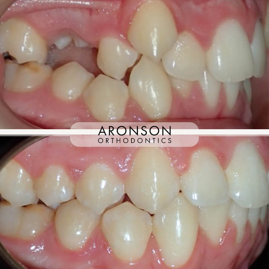 Severe crowding, Class II occlusion, Severe overbite, and Overjet. 

This case involved correction of a full-cusp Class II malocclusion with a severe overbite and overjet, a 90-degree rotated premolar, and a posterior crossbite. Treatment required braces, elastics, and precise bite coordination to align the arches and achieve a stable occlusion. Orthodontic treatment took about 24 months to complete. 

The final result shows dramatic improvement in function, symmetry, and esthetics — correcting the bite relationship, eliminating the crossbite, and restoring proper alignment for long-term stability and health.