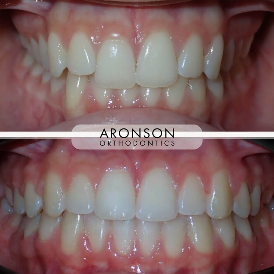 Severe deep bite, asymmetry incisors, class I occlusion, clear aligners

This case was treated with clear aligners to correct a severe deep bite and asymmetric upper incisors, while maintaining a Class I occlusion.

Precise aligner staging allowed for controlled bite opening and incisor leveling, creating a more balanced, even smile without the need for braces. The result is both functional stability and a natural esthetic improvement through a fully customized, minimally invasive approach taking about 18 months of orthodontic treatment.
