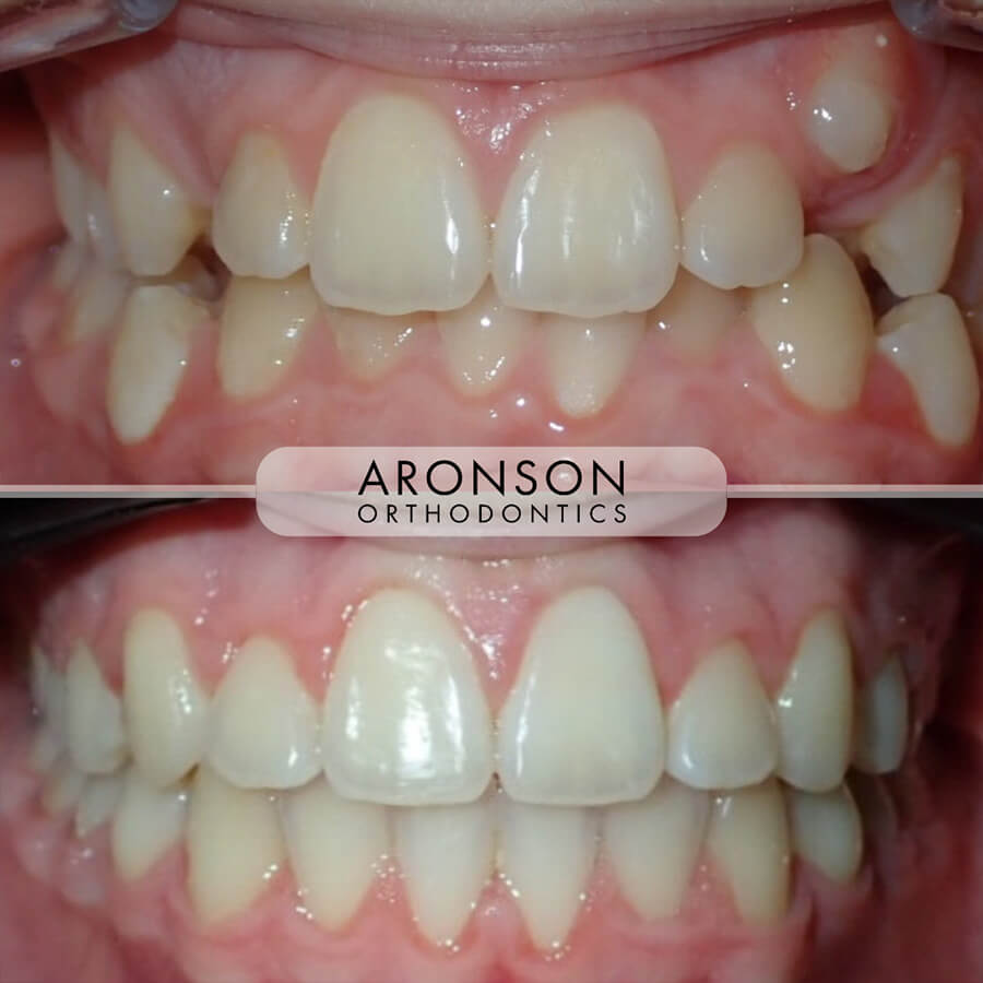 Severe deep bite, ectopic canine, posterior crossbite, midline non-coincidence.

This case presented with a severe deep bite, an ectopic (high) canine, a posterior crossbite, and non-coincident dental midlines. Treatment required comprehensive orthodontic mechanics in braces to coordinate the arches, align the ectopic tooth, and open the bite to a stable, functional position.

The final outcome shows balanced midlines, corrected crossbite, and improved vertical bite dimension, achieving both functional harmony and a well-proportioned, esthetic smile.