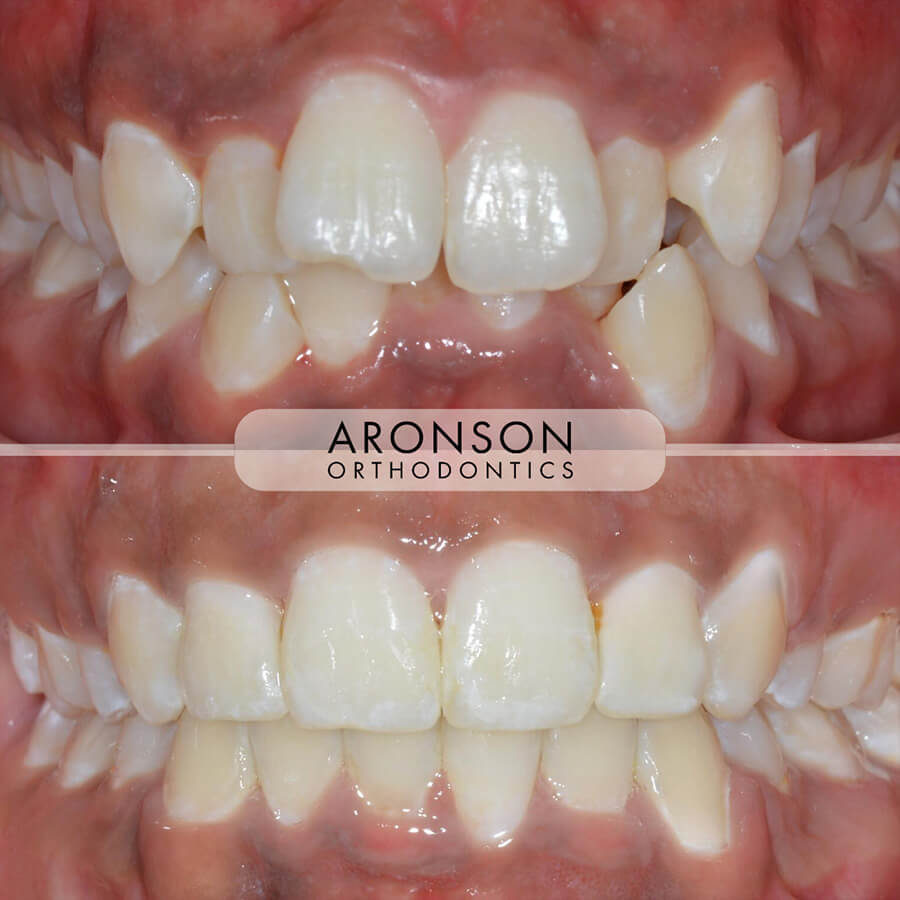 Severe crowding, narrow arch, severe overbite

Severe crowding, narrow arches, severe deep bite, treated with braces, tooth This case involved severe crowding, narrow dental arches, and a severe deep bite. Treatment included braces with four premolar extractions to create proper space for alignment — and the result is so natural you’d never know extractions were performed. Total treatment time was 24 months, with careful midline coordination to achieve symmetry and balance.

The final outcome shows ideal alignment, improved arch form, and a harmonious bite, combining functional precision with a refined esthetic result.