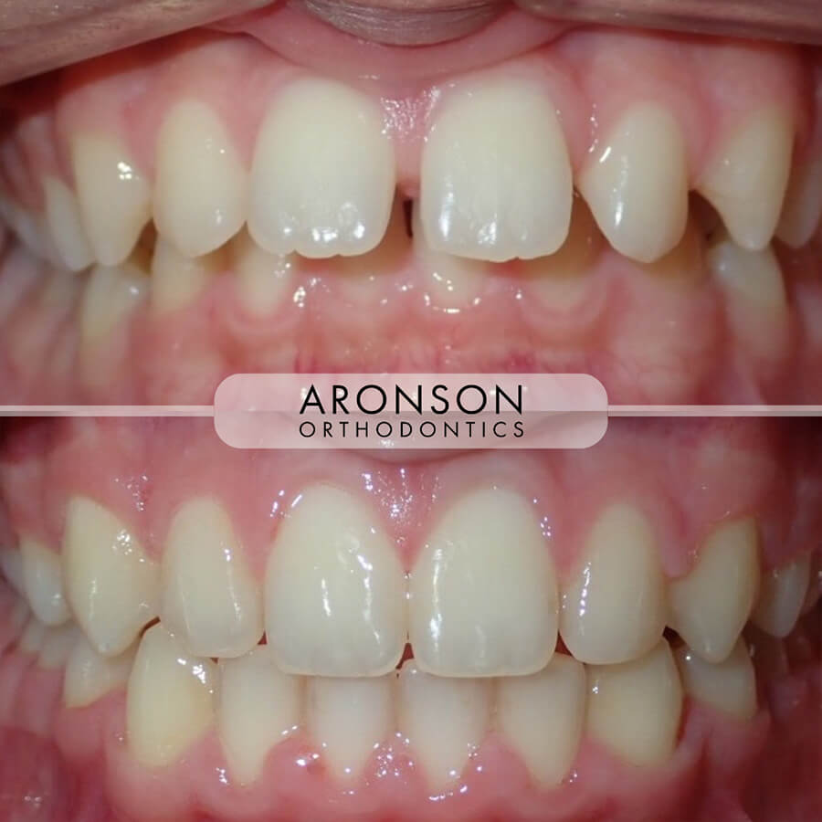 Flaring/proclination, spacing, class II, overjet, spacing

This case involved correction of flared and proclined front teeth, upper spacing, and a Class II bite with excessive overjet. Treatment with braces and elastics guided the teeth back into ideal alignment, closing all spacing and reestablishing proper incisor angulation.

The final result shows a balanced bite, improved lip support, and a more natural smile line, combining both esthetic refinement and functional correction.